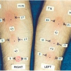 Six Mantoux tuberculin skin tests with 1, 2, 5, 10, 20, and 50 units .
